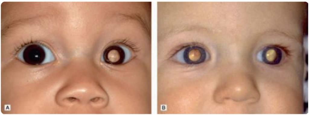 Exemplos de crianças acometidas pelo retinoblastoma. À esquerda a criança apresenta um câncer ocular unilateral. A criança à direita, está com a câncer bilateral. Foto: Reprodução